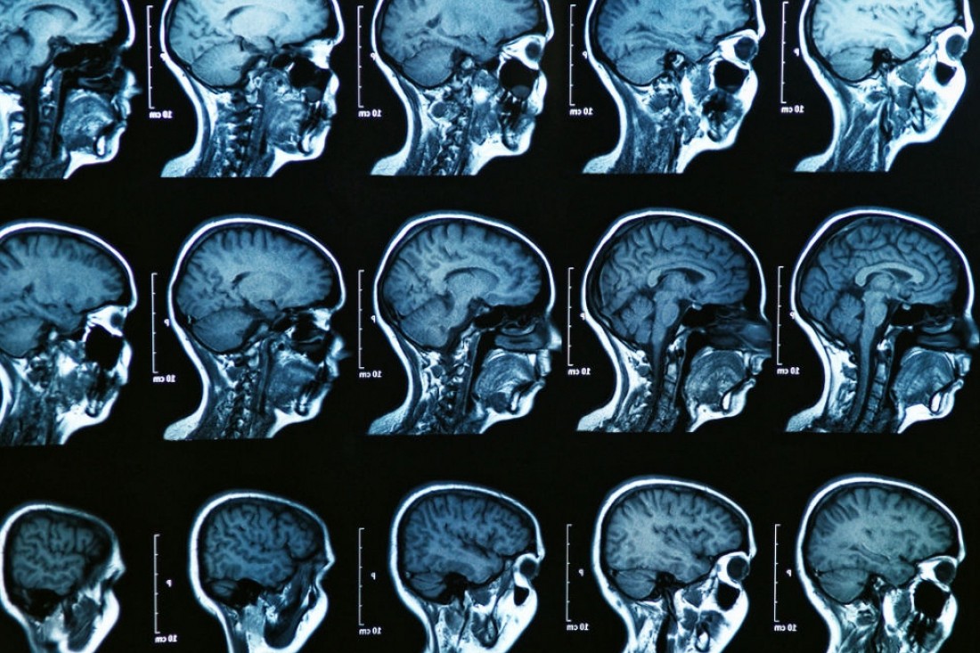 Ученые разработали лекарство нейростатин от болезни Альцгеймера