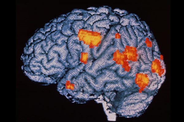 Ученые: Человеческий мозг способен самостоятельно излечиваться от шизофрении