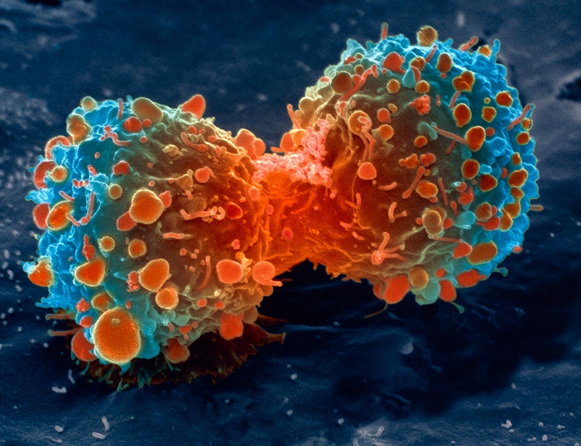 Ученые: Между раком и метаболизмом существует генетическая связь
