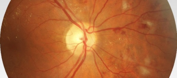 Как своевременно выявить ретинопатию сетчатки при диабете?