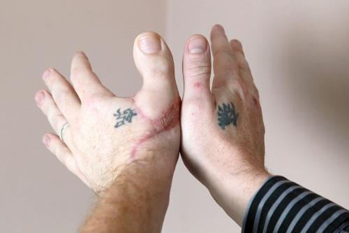 В США мужчине палец на руке заменили пальцем ноги