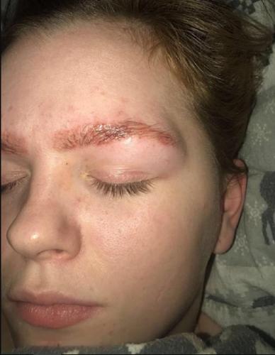 Студентка в Великобритании госпитализирована с ожогом после окрашивания бровей